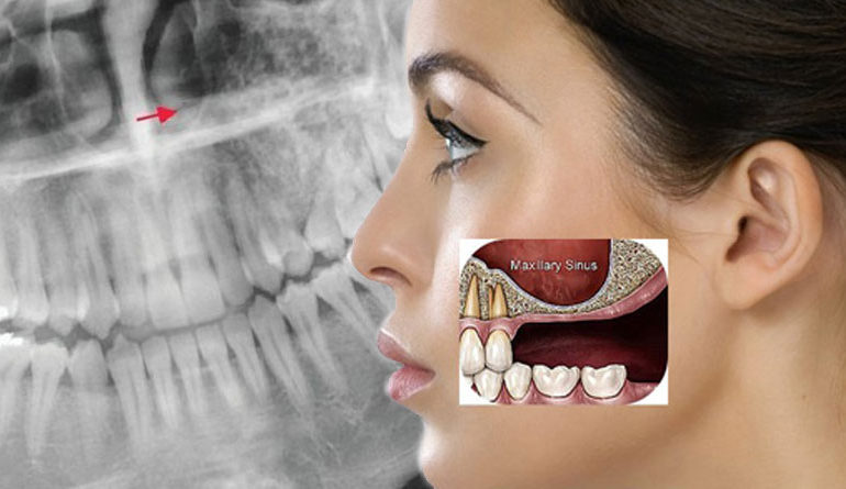 Sinus lifting