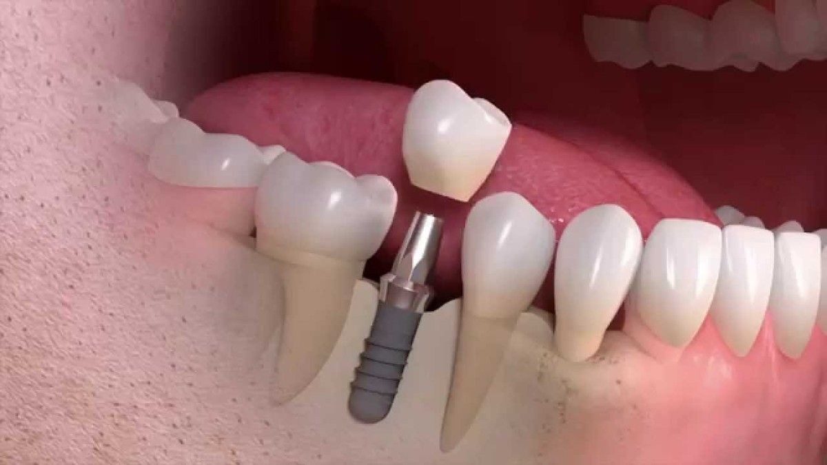 Principalele etape privind montarea unui implant dentar si metoda (procedura) de inserare :