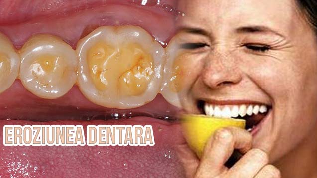 Eroziunea dentara